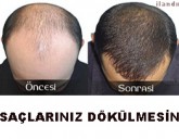 Kellik sorun olmaktan çıkıyor.